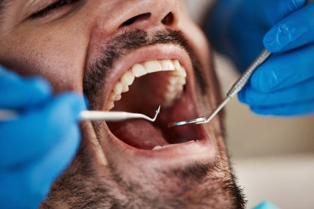 Best Broken or Cracked Tooth Emergency Dentist in Shokan, NY